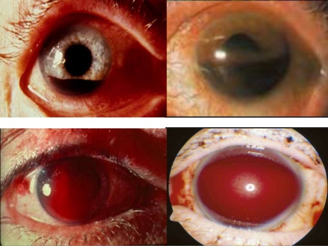 hyphema in dogs related keywords suggestions for hyphema hyphema in dogs related keywords suggestions for hyphema